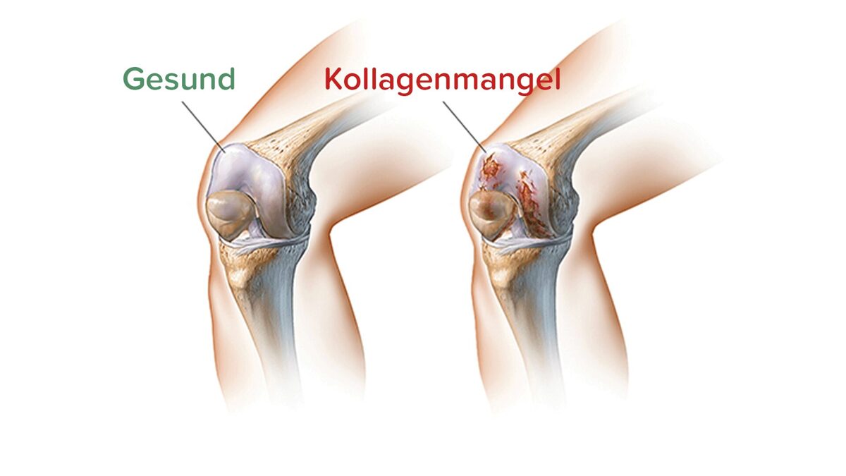 Kollagenmangel.jpg